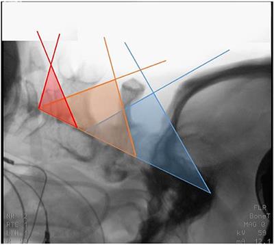Case Report: A Case Series Using Natural Anatomical Gaps—Posterior Cervical Approach to Skull Base and Upper Craniocervical Meningiomas Without Bone Removal
